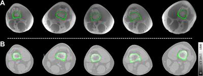 Simultaneous Quantitative Susceptibility Mapping of Articular Cartilage and Cortical Bone of Human Knee Joint Using Ultrashort Echo Time Sequences